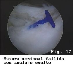 rodilla rotura menisco sutura