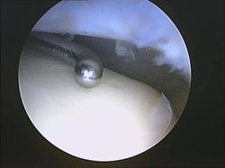 exploracion artroscopica lesion esguince externo tobillo