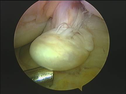 La elección de la plastia en la sustitución del ligamento cruzado anterior de la rodilla