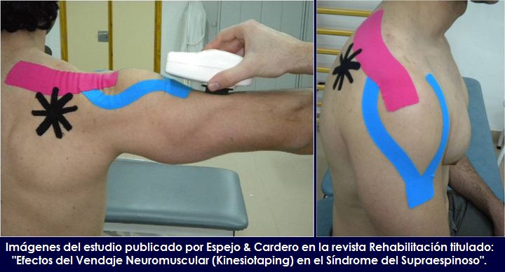 Estudio publicado sobre los Efectos del Vendaje Neuromuscular (Kinesiotaping) en el Sndrome del Supraespinoso
