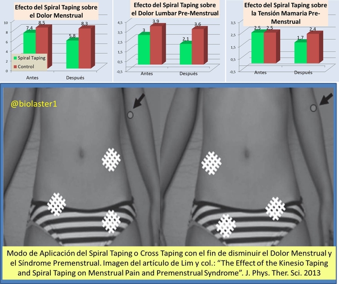 Efectividad del Cross Patching o Spiral Taping en la reducción del Dolor Menstrual y en la prevención del Síndrome Pre-Menstrual
