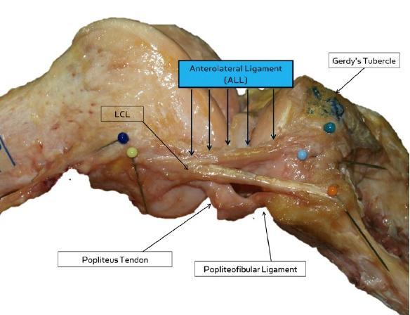 Describen un Nuevo Ligamento en la Rodilla Humana