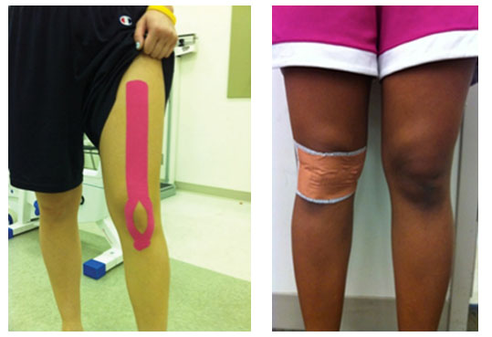 Comparacin entre Kinesiotaping y tcnica McConnell  en el dolor anterior de rodilla