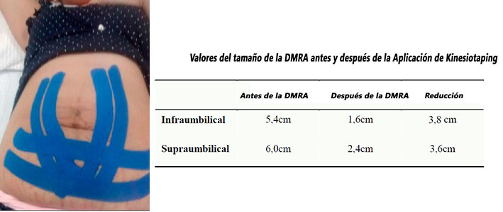 Vendaje kinesiotaping aplicado en la diástasis abdominal en el postparto