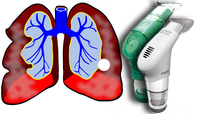 Entrenamiento Inspiratorio en asmticos: mejora de calidad de vida, funcionalidad y disminucin de sntomas