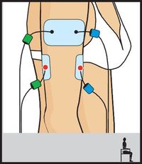 electroestimulacion COMPEX One entrenamiento musculatura rehabilitacion fuerza posicin electrodos marcar abdominales