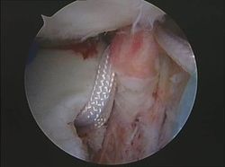 lesion hombro rotura ligamento plastia artroscopia