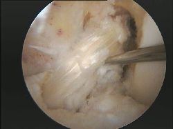 plastia rotura ligamento cruzado anterior artroscopia