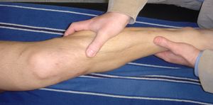 test resalte rotacion interna inestabilidad rodilla ligamento cruzado anterior LCA