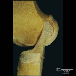 inestabilidad rodilla ligamento cruzado anterior LCA