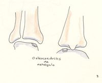pie tobillo cartilago osteocondritis