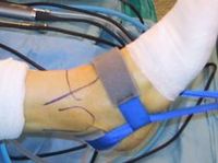 tobillo ankle articulacion tratamiento artroscopia